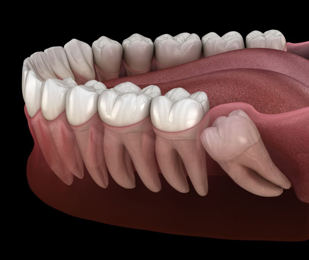 Recomandări și îngrijiri după finalizarea extracției dentare