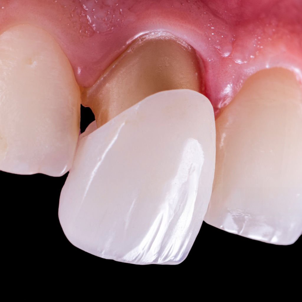 Avantajele coroanelor  dentare din ceramică