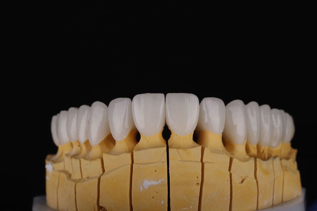 Fațetele dentare. Tot ce trebuie să știi despre fațete.