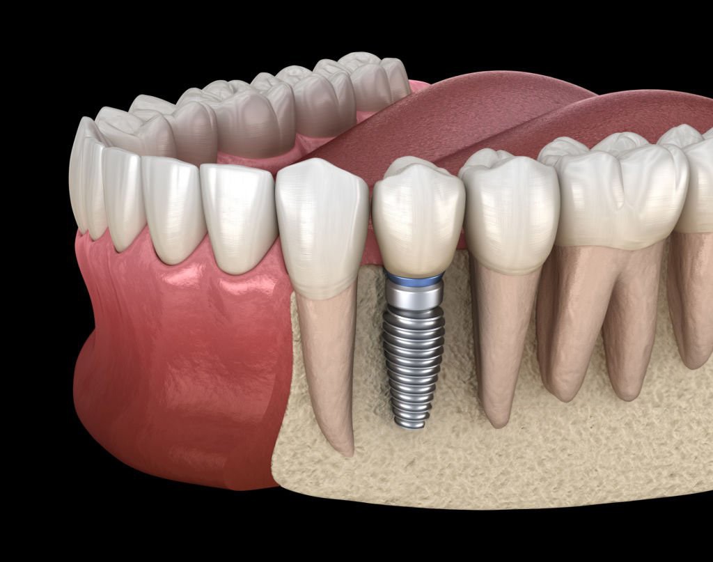 Avantajele unui implant dentar