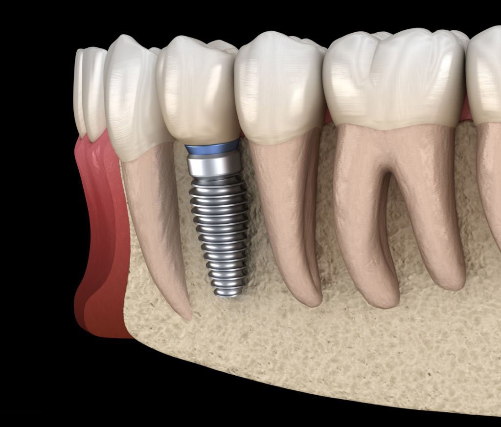 Coroana dentară pe implant. Tot ce trebuie să știi despre această lucrare protetică.